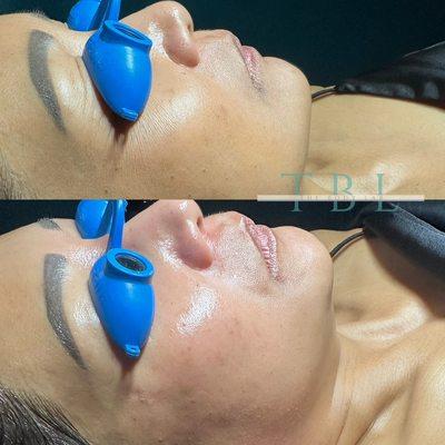 Custom facial; Hydration.