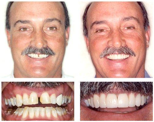 Cosmetic dentistry with Dr. Esler in Amarillo, Texas provides exhilarating results.