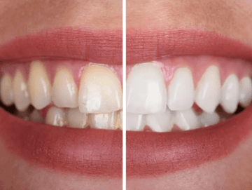 Teeth Whitening