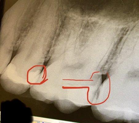 Dental x-Ray showing messed up filling by Dr. Gartner and new problem area.