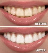 BRIGHTEN YOUR SMILE WITH OUR WHITENING TREATMENT!