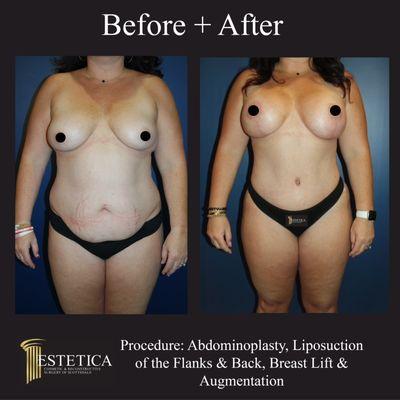 Abdominoplasty, Liposuction of the Flanks & Back, Breast Lift & BBA