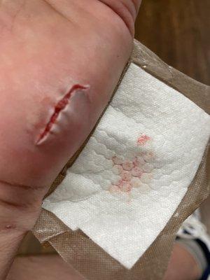 Nasty cut