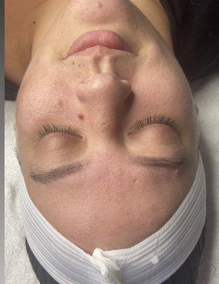 Before microdermabrasion!