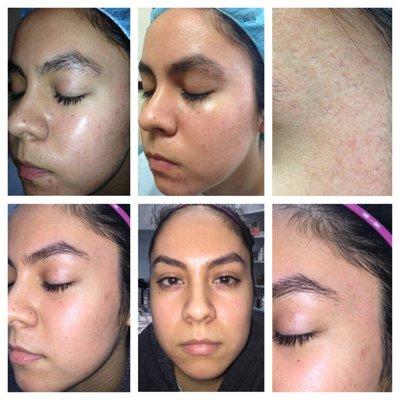 Acne Scar Treatment