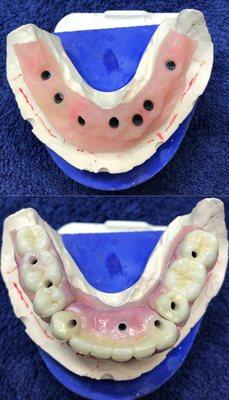 Full Lower implant