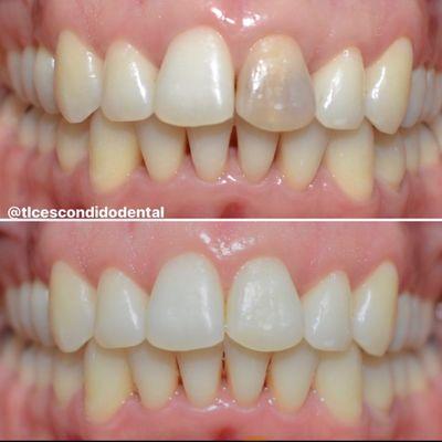 Before and After Internal Whitening