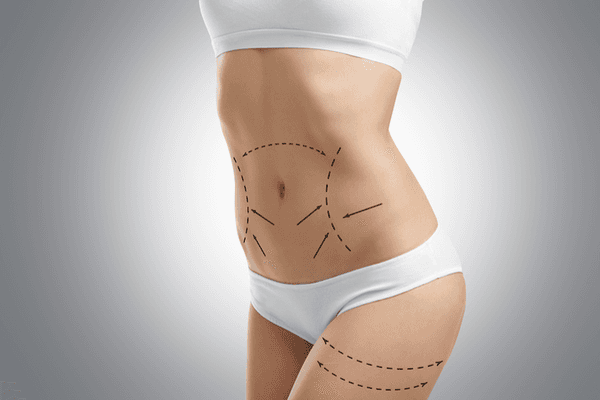 Liposuction