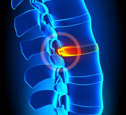 Herniated Disc