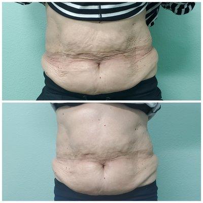 Skin tightening ** RF Body **