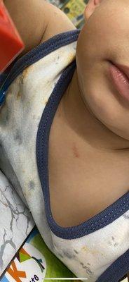 Scratches on baby neck from a different kid