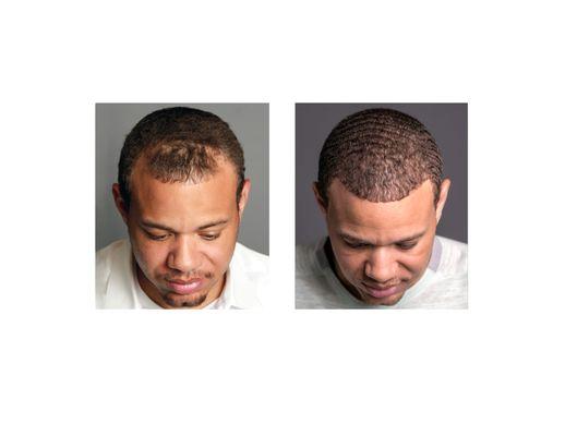 Bosley Hair Transplant & Restoration