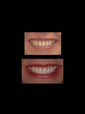 Invisalign Treatment Before and After Smile View