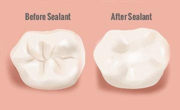 Protect your teeth with sealants! The grooves of your teeth are filled in, cavities kept out.