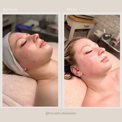 Hydrafacial plus dermaplane post glow