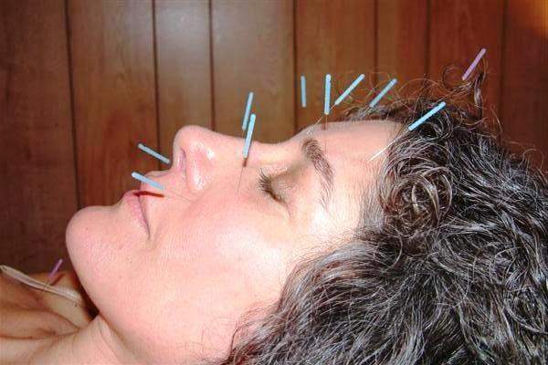 Cosmetic Acupuncture substitutes plastic surgery for a portion of price