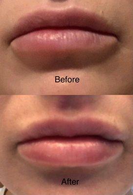 Before and After lip  correction with hyaluronic acid dermal filler