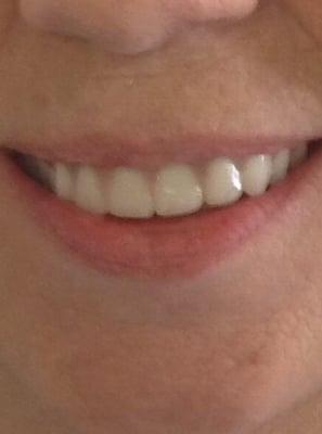 After. Big smile of a happy patient.