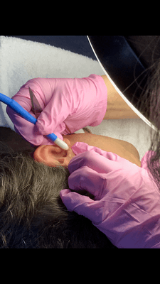 removing ear hair with electrolysis