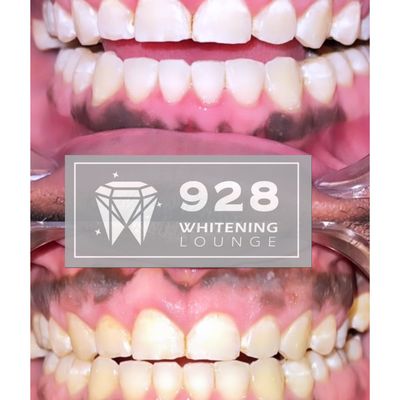 928 Whitening Lounge