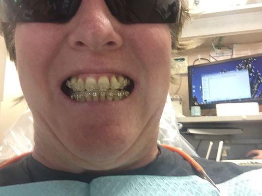 Braces, lots of great dentistry, and a caring staff made my smile possible