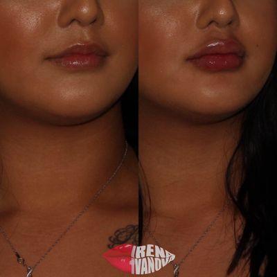 Before and after done by nurse injector, Irena. Versa filler was used for this lip augmentation.