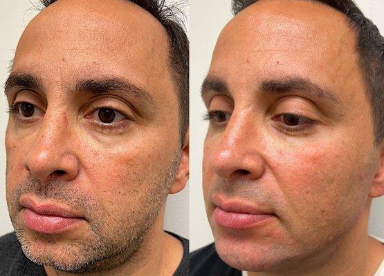 Full face rejuvenation and transformation - cheek, chin and jawline