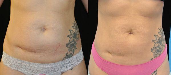 Radiofrequency Skin tightening