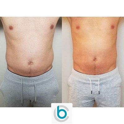 Bodcor's 4D Laser Fat Loss System is the latest in fat reduction technology for Inch Loss Treatments used for Men & Women.