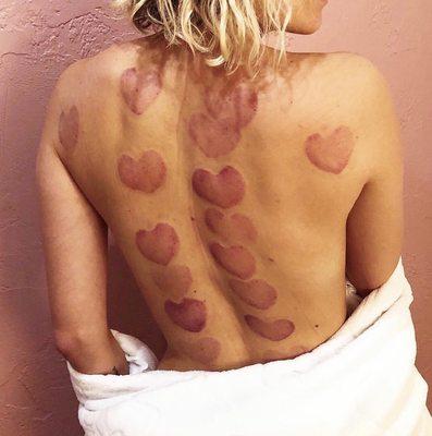 Therapeutic cupping