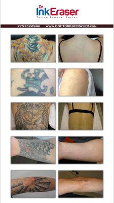 Birmingham Tattoo Removal