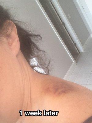 1 week later - Cupping mark on left shoulder