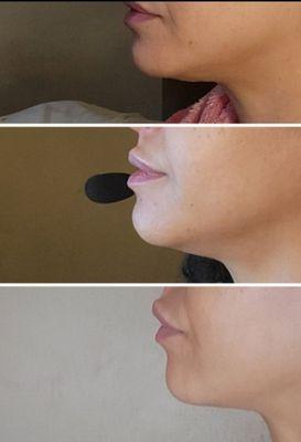 Real results from radio frequency to achieve skin tightening (results after 2 months 6 treatments)