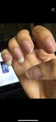 Visible damage and discoloration from the experience at eden nails