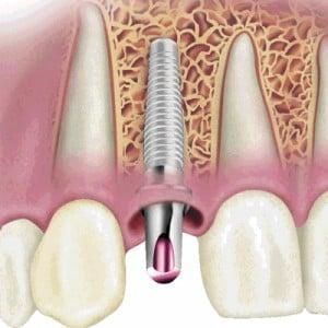 Implant Dentistry