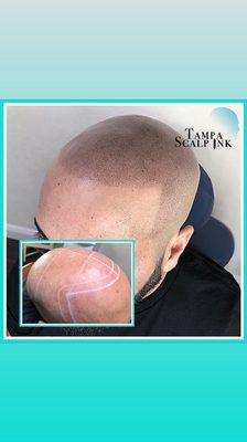 Customer use to wear hats everyday. Got his edge back with Scalp Micropigmentation.