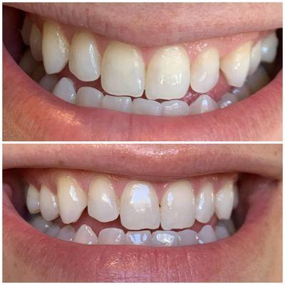 WhiteNow patient photo after 1 treatment. Enamel free and safe to treat every 3 months.