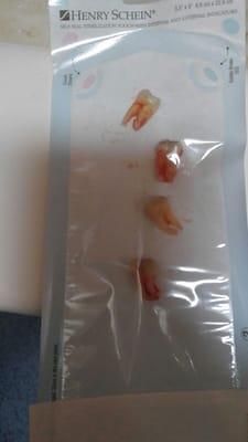 My wisdom teeth