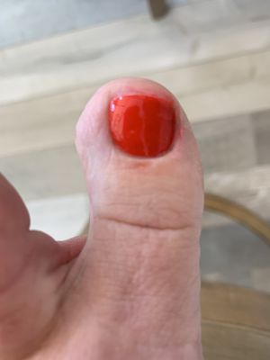 The cut on my toe. Plus a sloppy polish job.