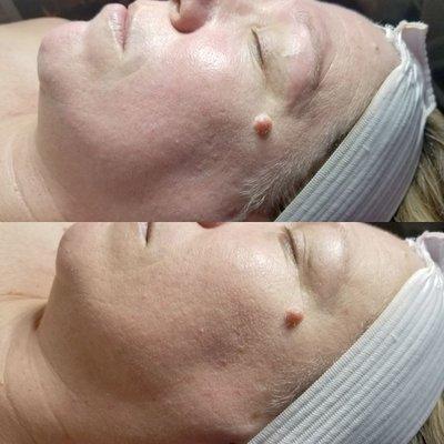 Before and after: microdermabrasion with LED Therapy