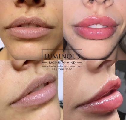 Full lip augmentation