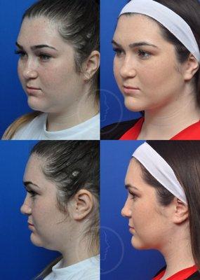 This patient was treated with Neck Liposuction at Garcia Facial Plastic Surgery.