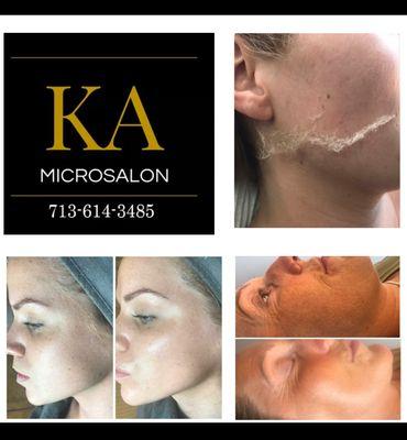 Dermaplane Facial $85