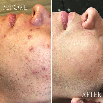 Acne Treatment, so happy for my client's success!