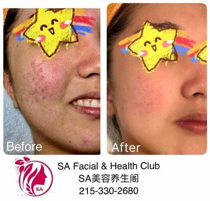 Chinese Herbal Acne Skin Care