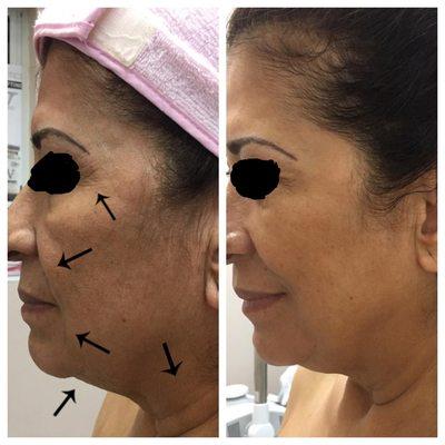 Antes y después (tratamientos para levantar el rostro y disminuir arrugas)