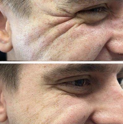 Crows feet botox injections