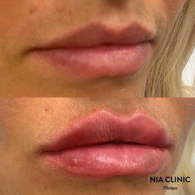 Kysse Lip Augmentation by Crystal.