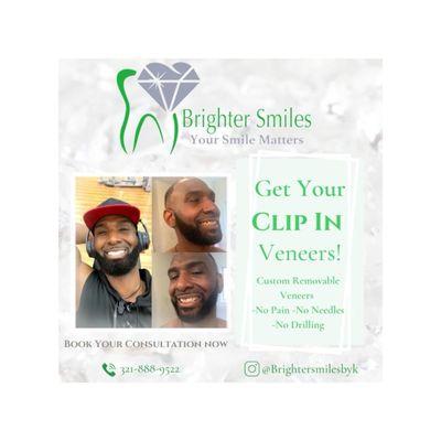 Clip in veneers