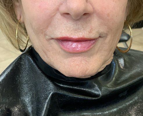 10 days after lip filler.